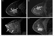 Association of Different MRI BIRADS Descriptors With Malignancy in Non Mass-Like Breast Lesions